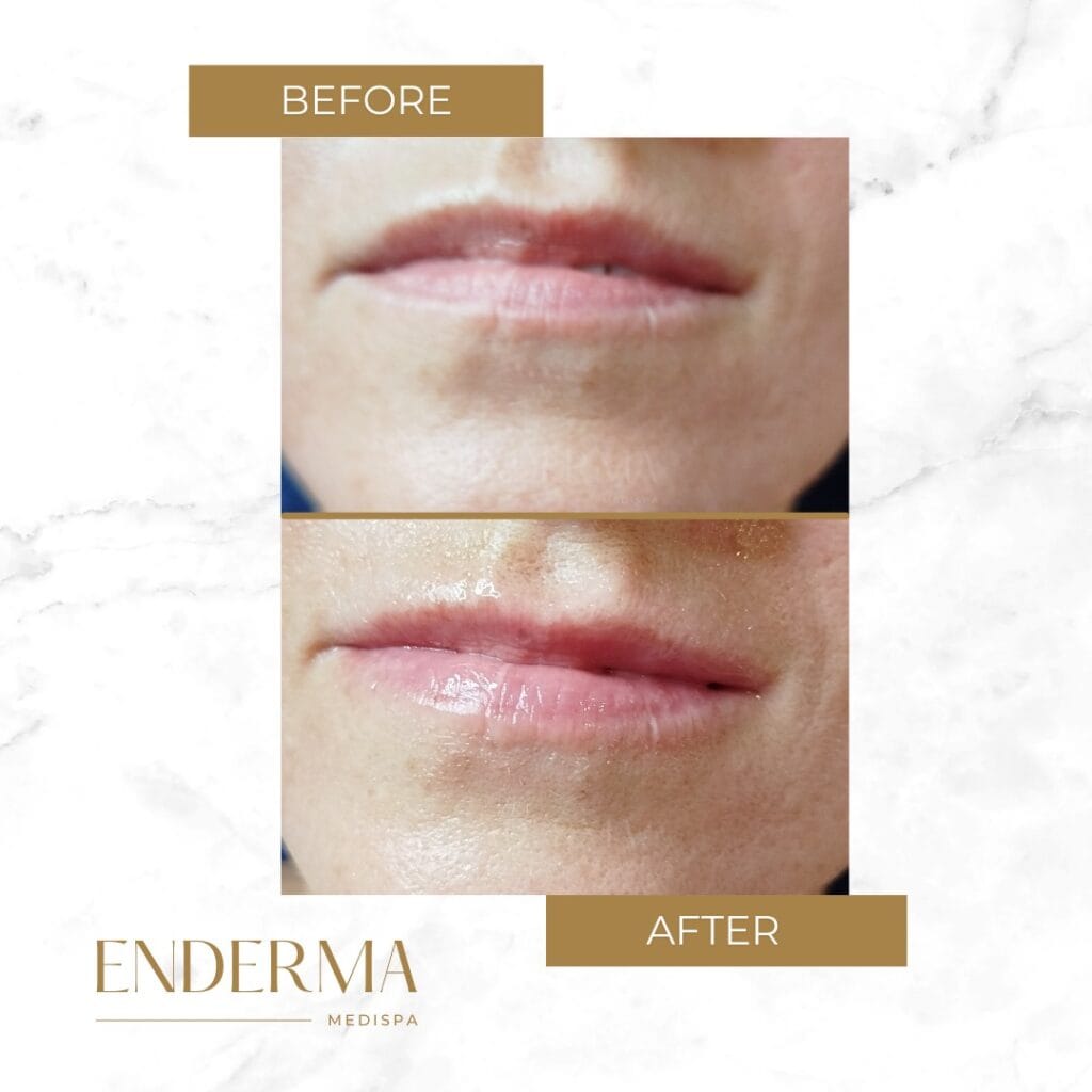 before and after Amico Tulip